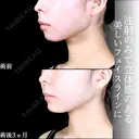 エラボトックス/顎ヒアルロン酸 before画像 サムネイル用