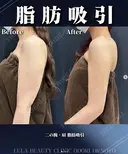 二の腕・肩脂肪吸引 after画像 サムネイル用