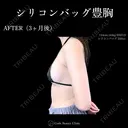 シリコンバッグ豊胸💎麻酔代込み 90日後 サムネイル用
