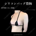 シリコンバッグ豊胸💎麻酔代込み 30日後 サムネイル用