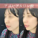アゴヒアルロン酸 1日後 サムネイル用
