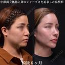 鼻整形 180日後 サムネイル用