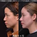 鼻整形 180日後 サムネイル用