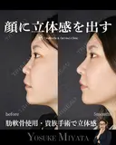 立体的な顔に 150日後 サムネイル用