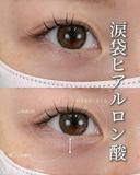 涙袋ヒアルロン酸 after画像 サムネイル用