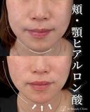 頬・顎ヒアルロン酸 after画像 サムネイル用