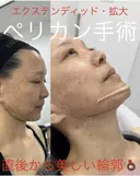 エクステンディット拡大ペリカン手術 after画像 サムネイル用