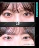 二重埋没｜シークレットダブル after画像 サムネイル用
