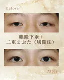 眼瞼下垂＋二重まぶた（切開法） after画像 サムネイル用