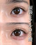 涙袋ヒアルロン酸 after画像 サムネイル用