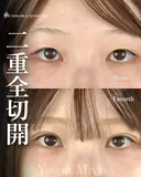 二重切開でミックス型 before画像 サムネイル用