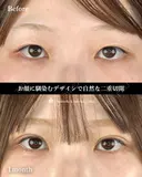 二重切開でミックス型 30日後 サムネイル用