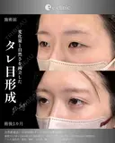 タレ目形成×二重整形 after画像 サムネイル用