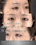 タレ目形成×二重整形 before画像 サムネイル用