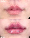 唇ヒアルロン酸 before画像 サムネイル用