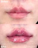 唇ヒアルロン酸 after画像 サムネイル用