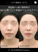 高川医師の脂肪吸引症例 after画像 サムネイル用