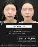 高川医師の脂肪吸引症例 after画像 サムネイル用