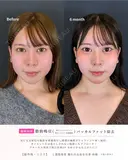 脂肪吸引+バッカルファット除去 after画像 サムネイル用