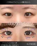 目元複合オペ（自然癒着法・まぶた脂肪取り・白目拡大術・目の下のふくらみ取り） after画像 サムネイル用