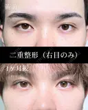 二重埋没法 30日後 サムネイル用