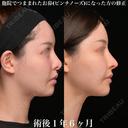 他院鼻修正 540日後 サムネイル用