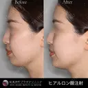 ヒアルロン酸注入（あごの輪郭を整える治療） after画像 サムネイル用