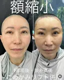 前額リフト・こめかみリフト before画像 サムネイル用