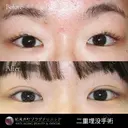 二重埋没法3点留 before画像 サムネイル用