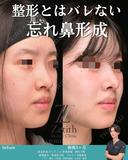 忘れ鼻形成 before画像 サムネイル用
