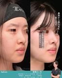 忘れ鼻形成 90日後 サムネイル用