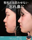 忘れ鼻形成 90日後 サムネイル用