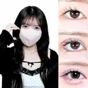 眼瞼下垂(たるみ取り併用)/目尻切開/タレ目形成術/皮膚切除 180日後 サムネイル用