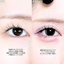 眼瞼下垂(たるみ取り併用)/目尻切開/タレ目形成術/皮膚切除 before画像 サムネイル用