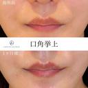 口角挙上 before画像 サムネイル用