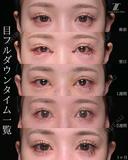 タレ目を含む目フル 30日後 サムネイル用