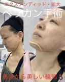 エクステンディッド拡大ペリカン手術 after画像 サムネイル用