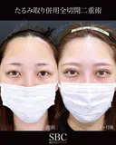たるみ取り併用全切開二重術 before画像 サムネイル用