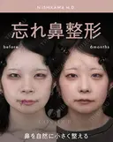忘れ鼻整形 before画像 サムネイル用