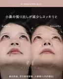忘れ鼻整形 180日後 サムネイル用