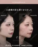 忘れ鼻整形 180日後 サムネイル用