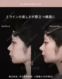 忘れ鼻整形 180日後 サムネイル用