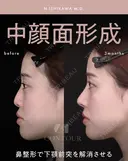 忘れ鼻整形 90日後 サムネイル用