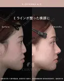 忘れ鼻整形 90日後 サムネイル用