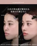 忘れ鼻整形 90日後 サムネイル用