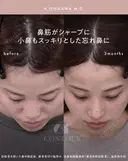 忘れ鼻整形 90日後 サムネイル用