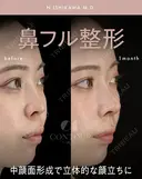 忘れ鼻整形 before画像 サムネイル用