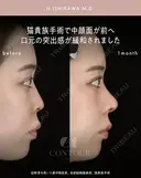 忘れ鼻整形 30日後 サムネイル用
