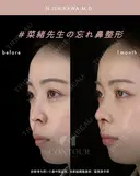 忘れ鼻整形 30日後 サムネイル用