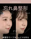 忘れ鼻整形 30日後 サムネイル用